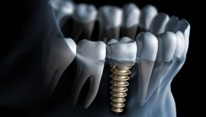 Dental Implant