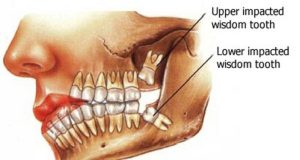 wisdom teeth infection before removal